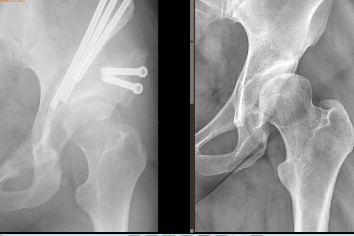 FOTO OSTEOTOMIA PERIACETABULAR FOTO OSTEOTOMIA PERIACETABULAR